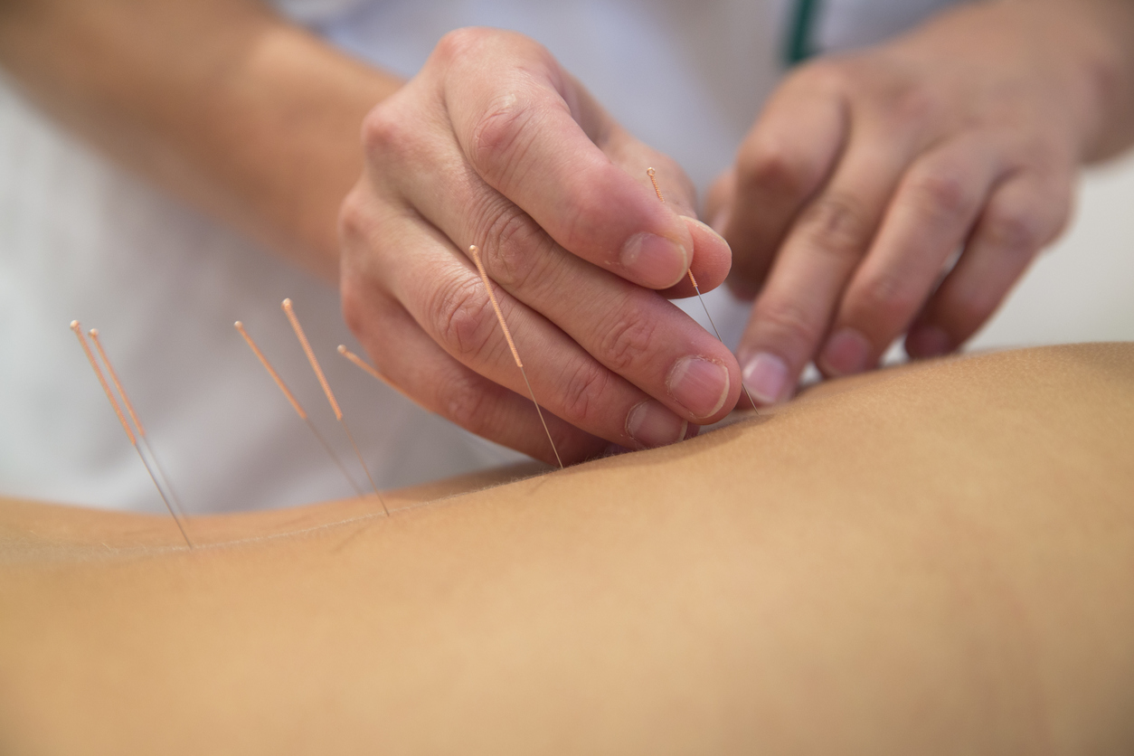 Understanding Acupuncture for Fertility: A Natural Solution